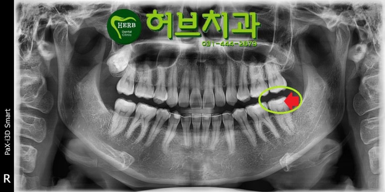 이전 레진하방에 충치 보임 엑스레이상 빨간 표시한 화살표가 이차충치부위임